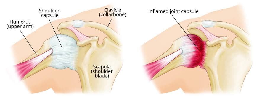 Frozen Shoulder: Why It Happens and How Physiotherapy Restores Movement