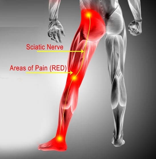 Sciatica: What Causes Leg Pain from the Back and How to Treat It